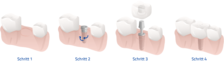 implantat ablauf