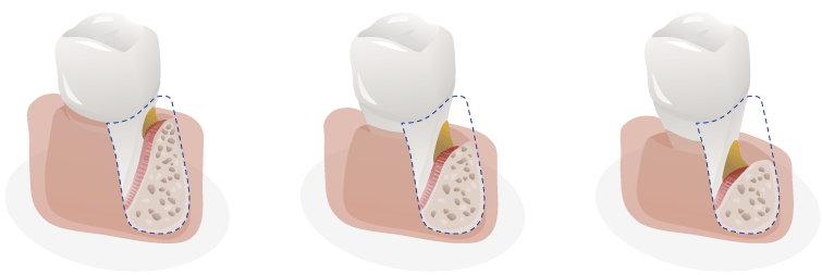 fortschreitende parodontitis